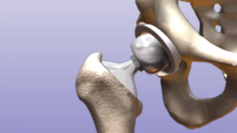 Hip Replacement surgery