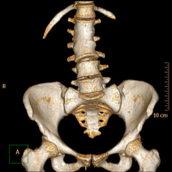 Spine I Orthopedic Implants Blog