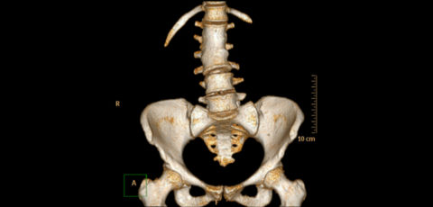 Spine I Orthopedic Implants Blog
