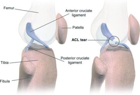 Type of Knee Ligament Injuries