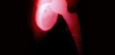 New Protocol May Decrease Hip Dislocation Risk