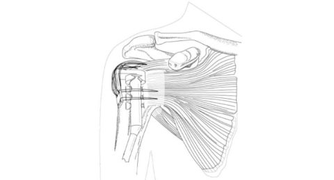 Rottat cuff - orthopaedic implant