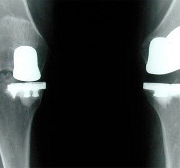 partial vs total knee replacement