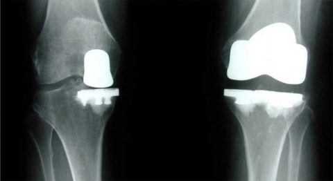 partial vs total knee replacement