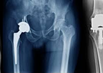 Hip and Knee Replacement surgery