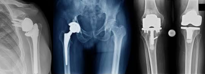 Hip and Knee Replacement surgery