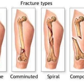 Different Types of fracture - Oblique,Comminuted, Spiral, Compound