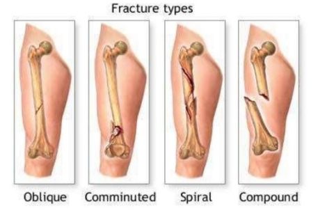 Different Types of fracture - Oblique,Comminuted, Spiral, Compound