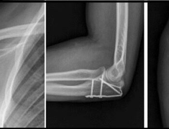 Fracture of joints I Orthopedic Implant