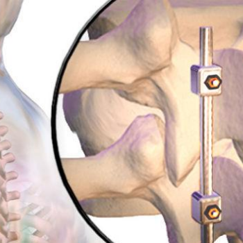 Postoperative Care for Spinal Fusion Surgery