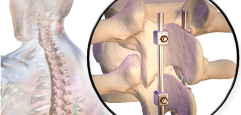 Postoperative Care for Spinal Fusion Surgery