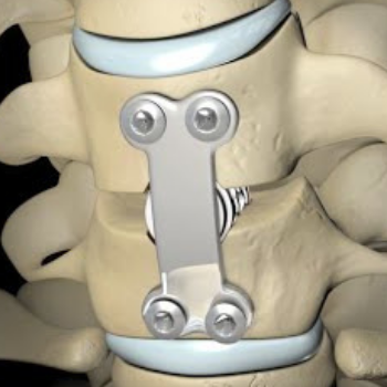 Anterior cervical discectomy and fusion(ACDF)